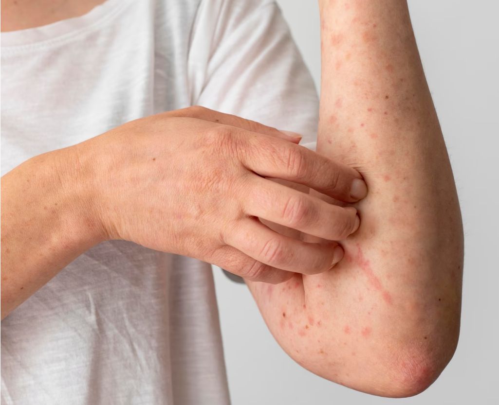DERMATITIS ECZEMA